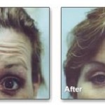 Wrinkle Reduction With Botox Cosmetic®