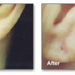 Ear Right Hole Repair