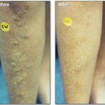 Varicose Veins Treated with Sclerotherapy