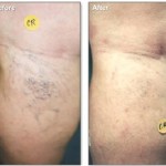 Spider Veins Treated with Sclerotherapy