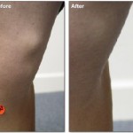 Varicose Veins Treated with EVLT