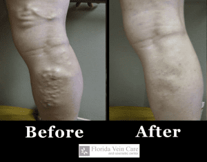 varicose veins before and after svelte