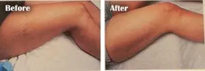 before and after sclerotherapy