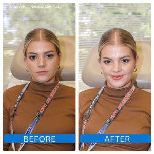 botox before and after