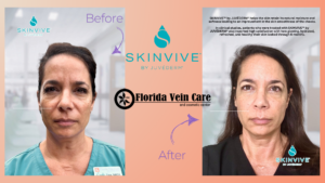 skinvive derma filler