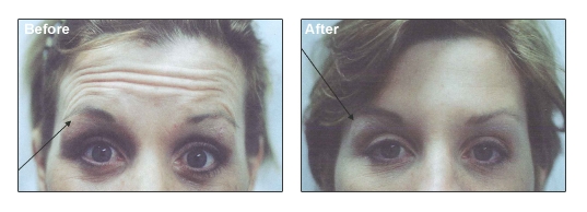 Wrinkle Reduction With Botox Cosmetic®