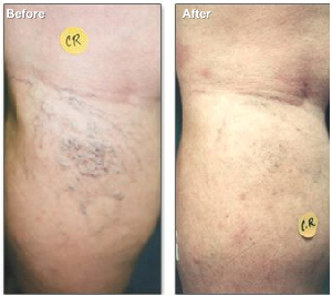 Spider Veins Treated with Sclerotherapy