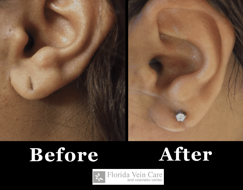 earlobe repair surgery orlando