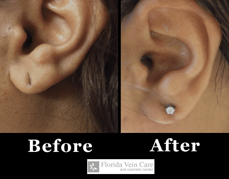 Best Ear Hole Repair- Earlobe Repair Surgery