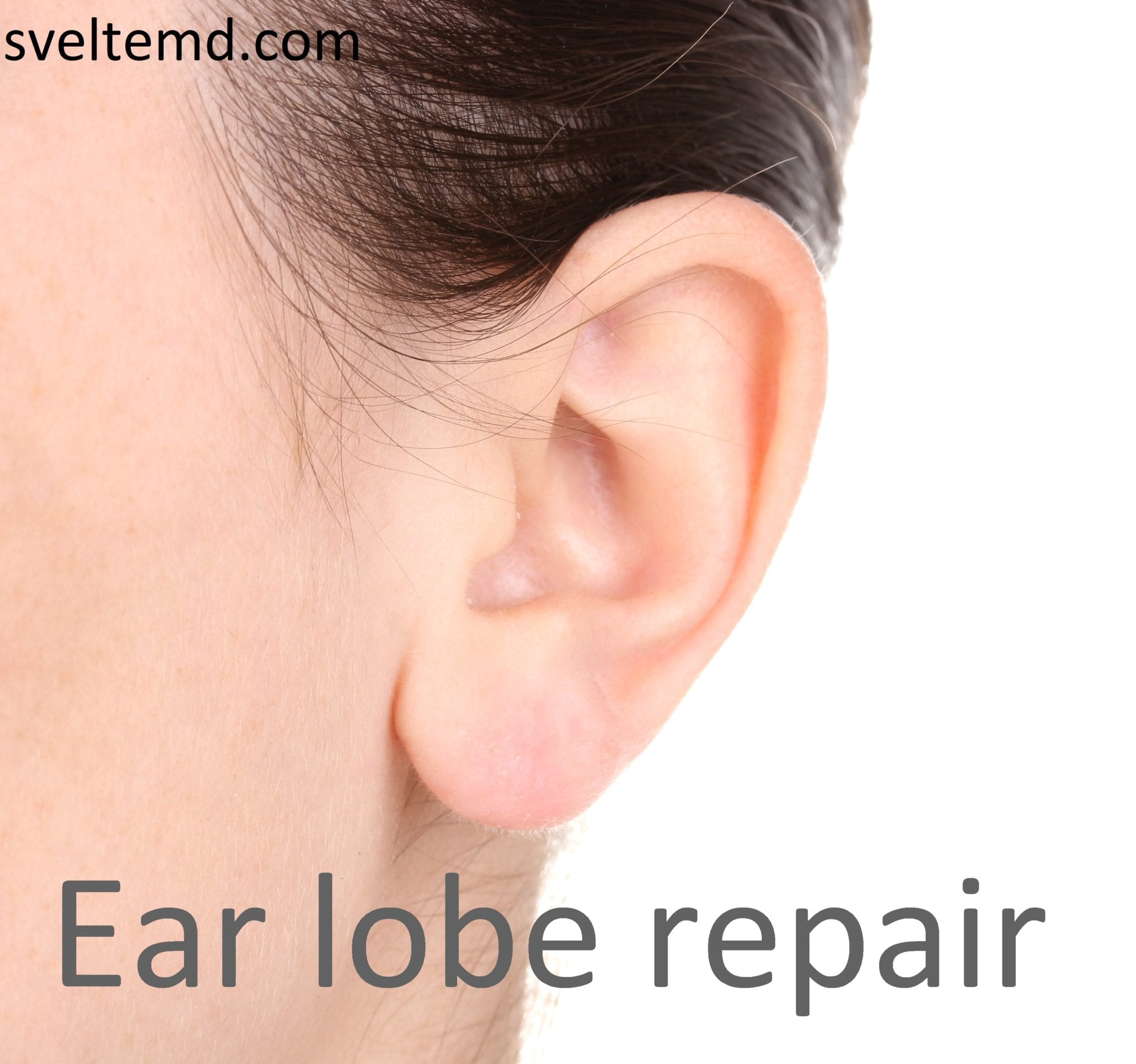 Advanced Homoeo Clinic - Are You Worried about Elongated Ear Lobe??? Do'nt  Worry, Here is a Non-surgical Ear Hole Repair. Hurry up
